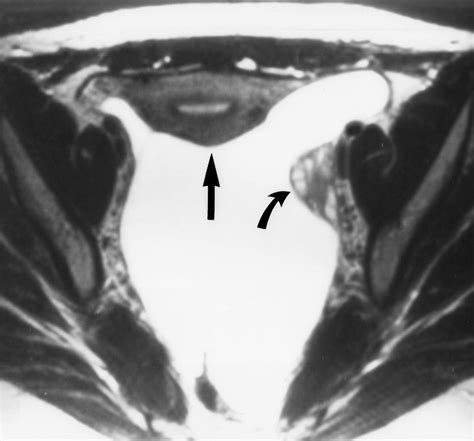 Uterine Leiomyomas Histopathologic Features Mr Imaging Findings