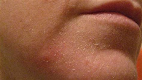 Dry Skin Patches On Face Not Itchy Top Secret Skin Tips