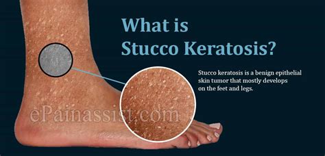 What Is Stucco Keratosis And Is It Harmfulcauses And Treatment Of