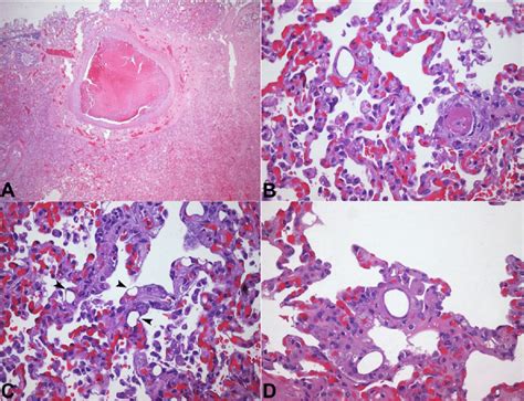 Photomicrography Of The Lung A Organizing Thrombus And Diffuse