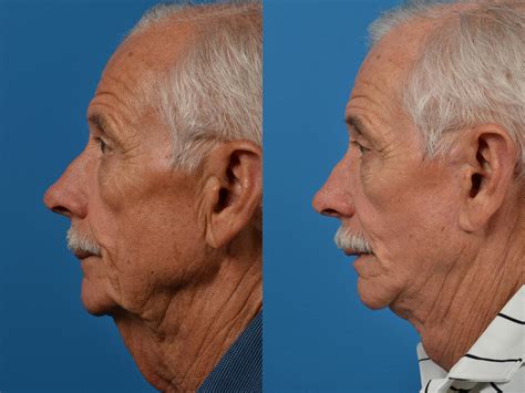 Mens Facelift Before And After Before And After