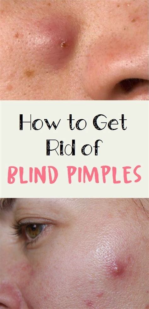 How To Get Rid Of Blind Pimples Blind Pimple Pimple Treatment