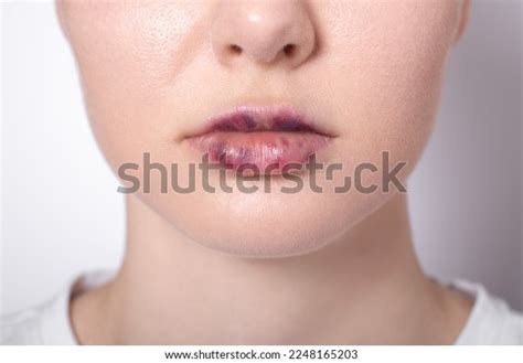 Real Womens Bruised Lips After Lip Stock Photo 2248165203 Shutterstock