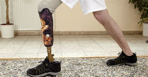 How To Learn To Walk On A Prosthetic Leg Livestrongcom