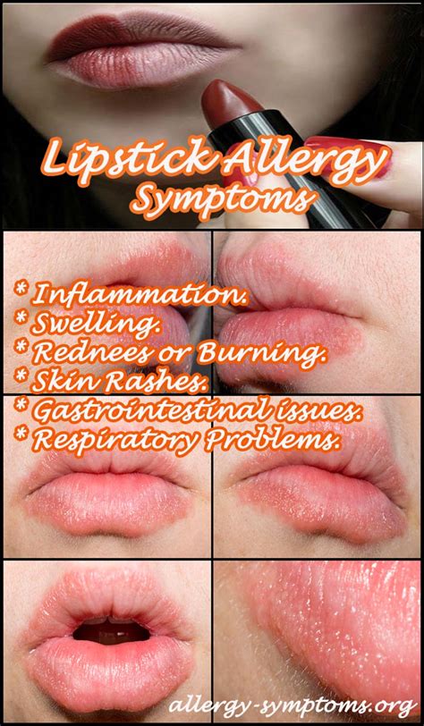 Lipstick Allergy Symptoms Causes And Treatment Allergy Symptoms