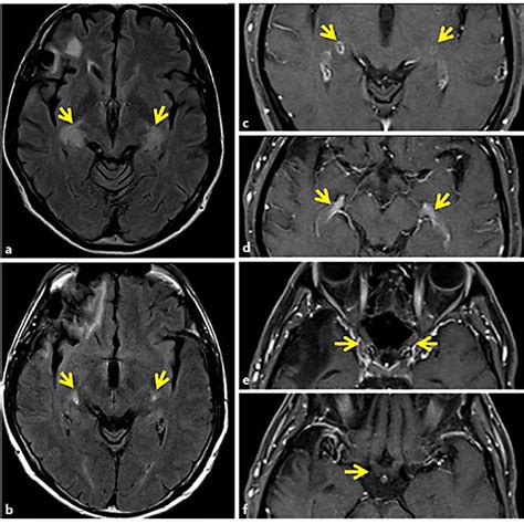 Mri Findings In The Brain A Flair Image At Day 1 Showing Abnormal