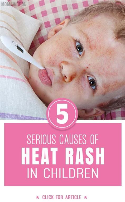 Heat Rashes In Children Types Symptoms And Home Remedies Riset