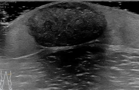 Pilomatricoma Ultrasound And Mri Image