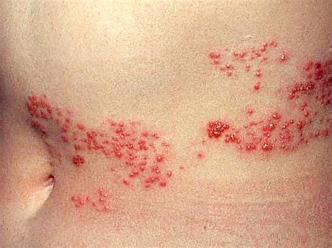 Is It Shingles Myths About Painful Illness Graphic Images Cbs News
