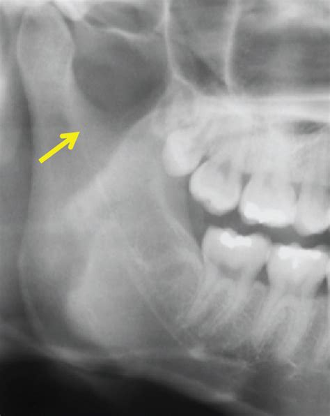 Time Course Of Osteoma In The Right Mandibular Notch By Panoramic