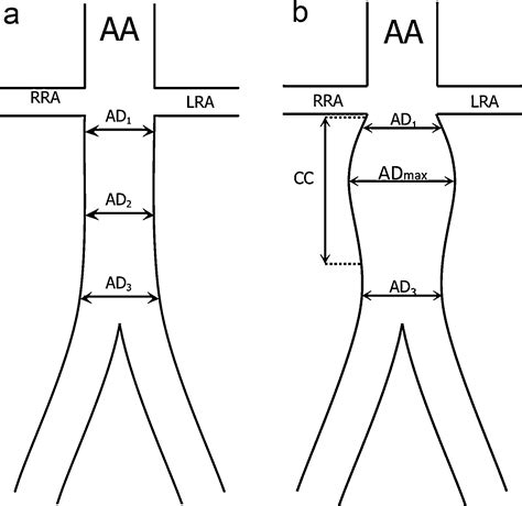 Abdominal Aorta Diameter