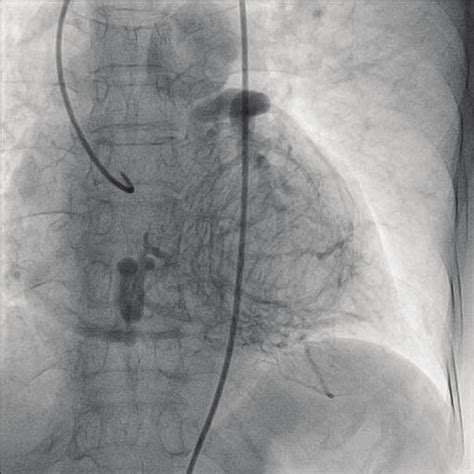 Rao Right Anterior Oblique View Of Lad And Lcx Arteries Opacifying