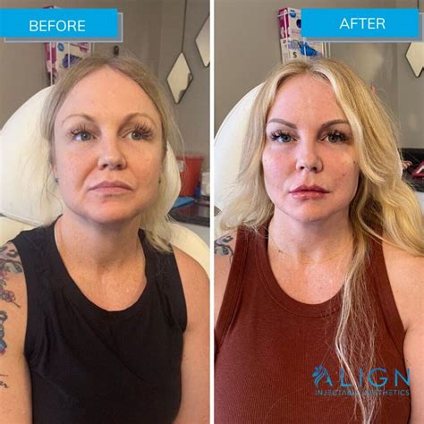 Before And After Cheek Filler For Anti Aging Align Injectable Aesthetics