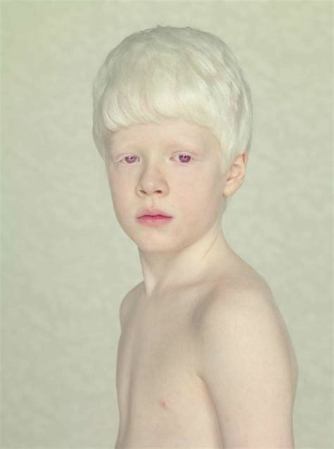 Gustavo Lacerda Albino Human Albinism Albino