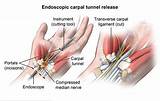 Endoscopic Carpal Tunnel Release Recovery Time Images