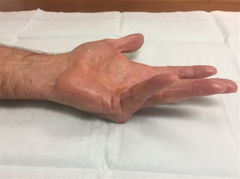 Needle Aponeurotomy For Dupuytrens At Raleigh Hand John Erickson Md