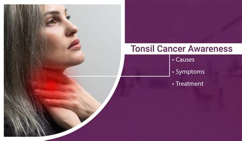 Tonsil Cancer Awareness Causes Symptoms And Treatment