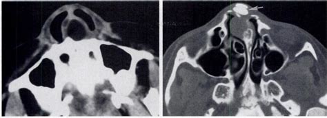 Dermoid Cyst In A 1 3 Year Old Girl With A Bifid Nose And A Chronic