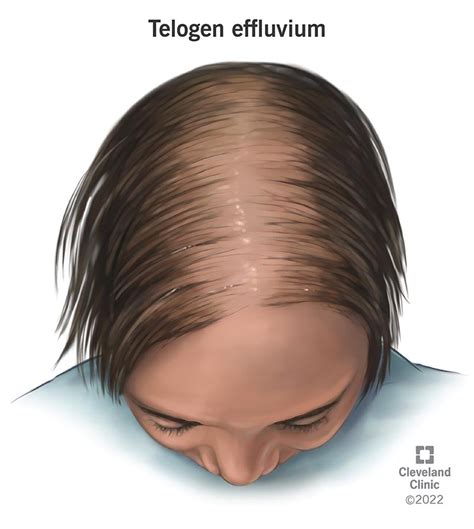 Telogen Effluvium Symptoms Causes Treatment And Regrowth