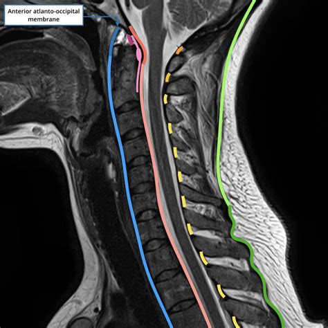 Ligaments Of The Cervical Spine Annotated Image Radiology Case