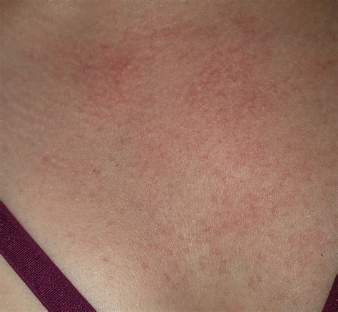 Pmle Sun Allergy Rash Pictures Life Without Dressing