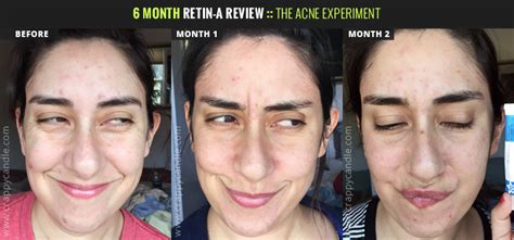 6 Month Retin A Review The Acne Experiment Crappy Candle