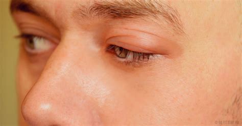 Blepharitis Sore Itchy Red Eye Causes And Symptoms