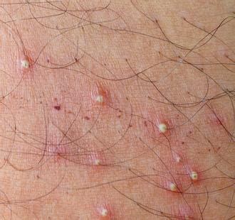 What Are Hair Follicle Infections
