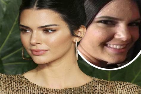 Kendall Jenner Opens Up On Acne Battle Which Left Her ‘running Home