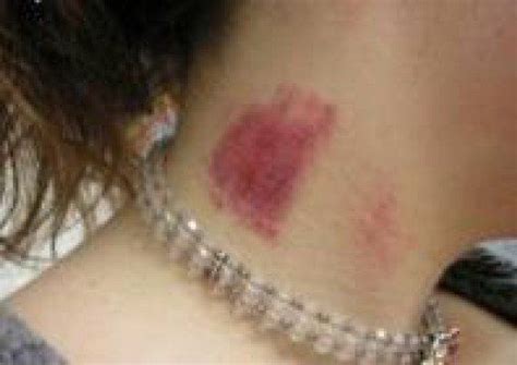 how to get rid of a hickey in less than 4 steps hickeys hickey remedies cute couples cuddling