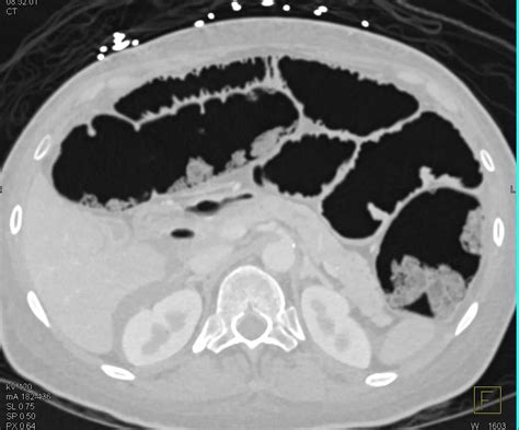 Pneumatosis With Ischemic Bowel Due To Superior Mesenteric Artery Sma