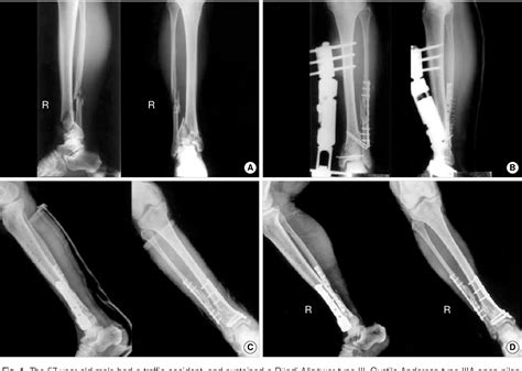 Treatment Of Tibial Pilon Fractures With Two Staged Delayed Open