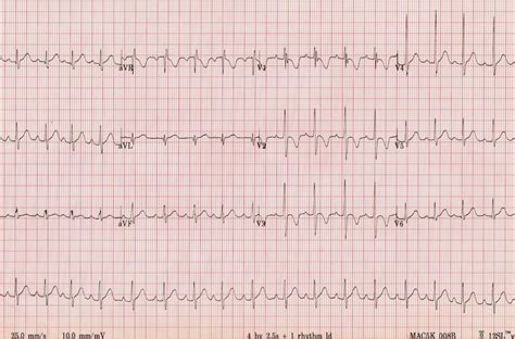 Normal 2 Year Old Paed Ecg Emcage