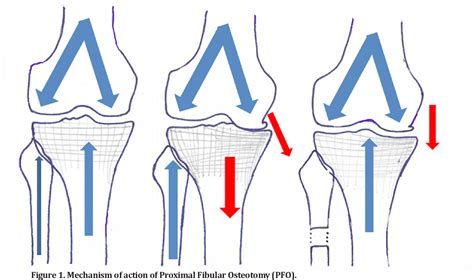 Pdf A Critical Review Of Proximal Fibular Osteotomy For Knee