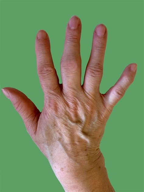 Osteoarthritis In The Hand Aberdeen Virtual Hand Clinic