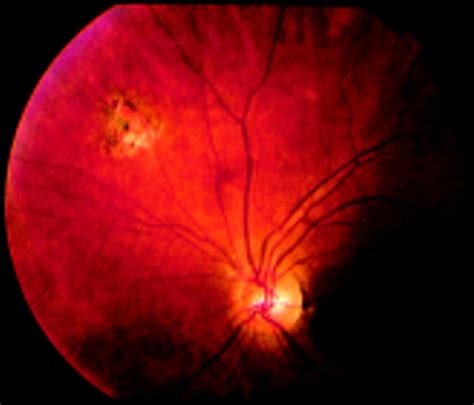 Unilateral Enlargement Of The Blind Spot A Diagnostic Dilemma