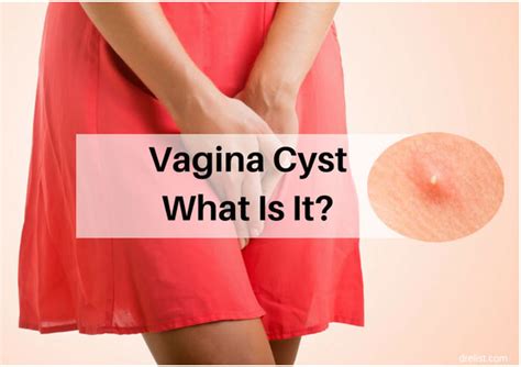 Causes And Symptoms Of Cyst Below Your Waist Do Not Ignore It Find Natural Remedy For Cyst