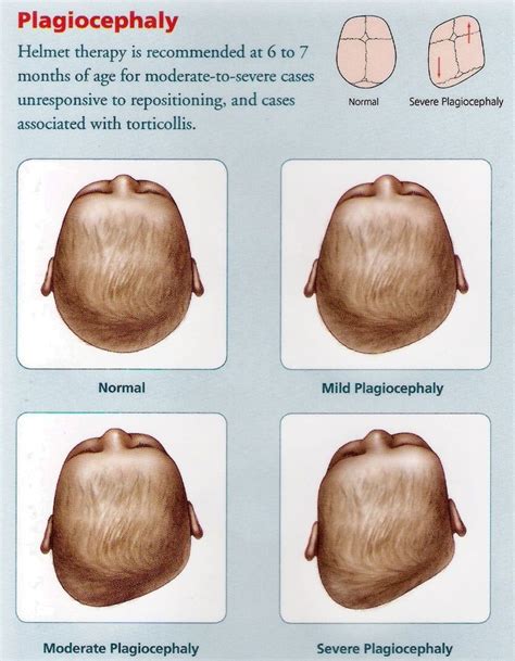 Plagiocephaly Flat Head Syndrome Baby Head Shape Flat Head Baby
