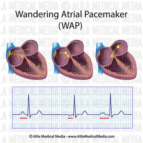 Alila Medical Media Wandering Atrial Pacemaker Wap Medical