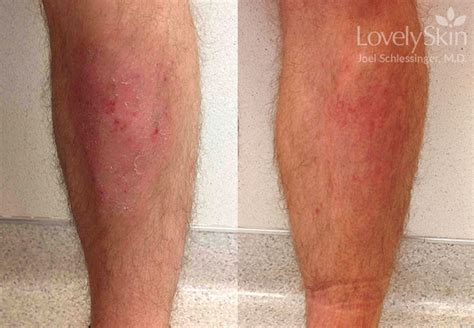 Omaha Dermatology Psoriasis Treatment Skin Specialists Pc Lovelyskin™