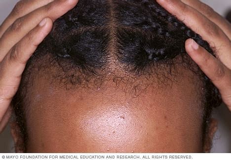 Hair Loss Symptoms And Causes Mayo Clinic