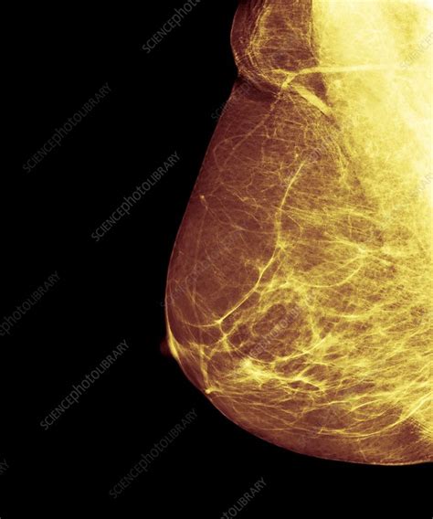 Breast Cancer Screening X Ray Stock Image F0135756 Science
