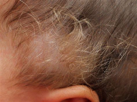 Woolly Hair Woolly Hair Naevus En Woolly Hair Syndroom