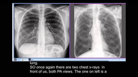 Normal Lung X Ray Vs Copd Asthma Lung Disease