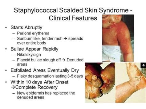 Staphylococcal Scalded Skin Syndrome Nurse Info