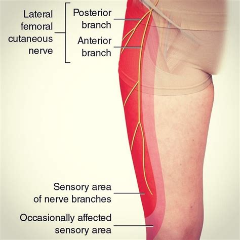 Meralgia Paresthetica Ziekte Info Neurologen Alrijne