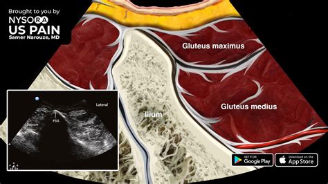 Ultrasound Pain Block Tip Of The Week Piriformis Muscle Injection