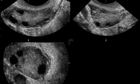 Three‐dimensional Ultrasound Improves The Interobserver Reliability Of