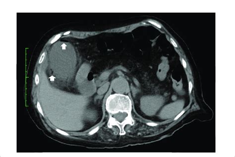 Ct Scan Of The Abdomen Abdominal Ct Showing Air In The Walls Arrows