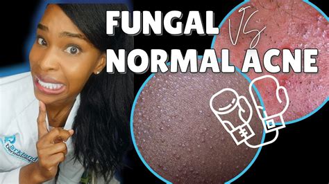 Fungal Acne Vs Normal Acne Youtube